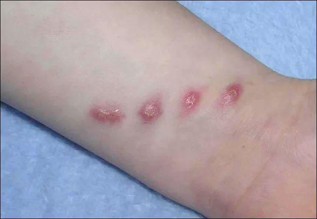 常识科普：猫爪热并不可怕